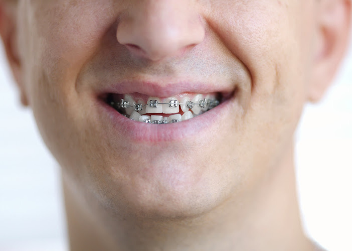 how much do braces cost uk over 18